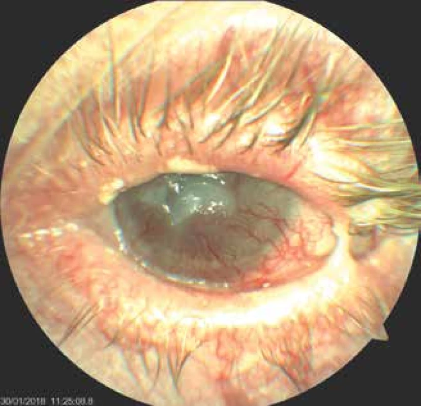 Left eye of patient – incipient lysis of corneal leucoma,
condition after partial tarsorrhaphy, eye irritated