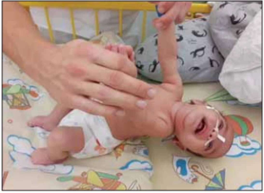 Těžká hypotonie u kojence se SMA I.<br>
Fig. 1. Severe hypotonia in an infant with SMA I