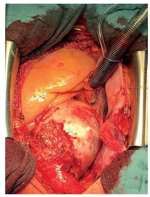 Perioperačné fotografie (kraniokaudálny pohľad)<br>
Objemná aneuryzma ascendentnej aorty.<br>
Fig. 2: Intraoperative photography (cranio-caudal view)<br>
Showing a huge aneurysm of the ascending aorta.