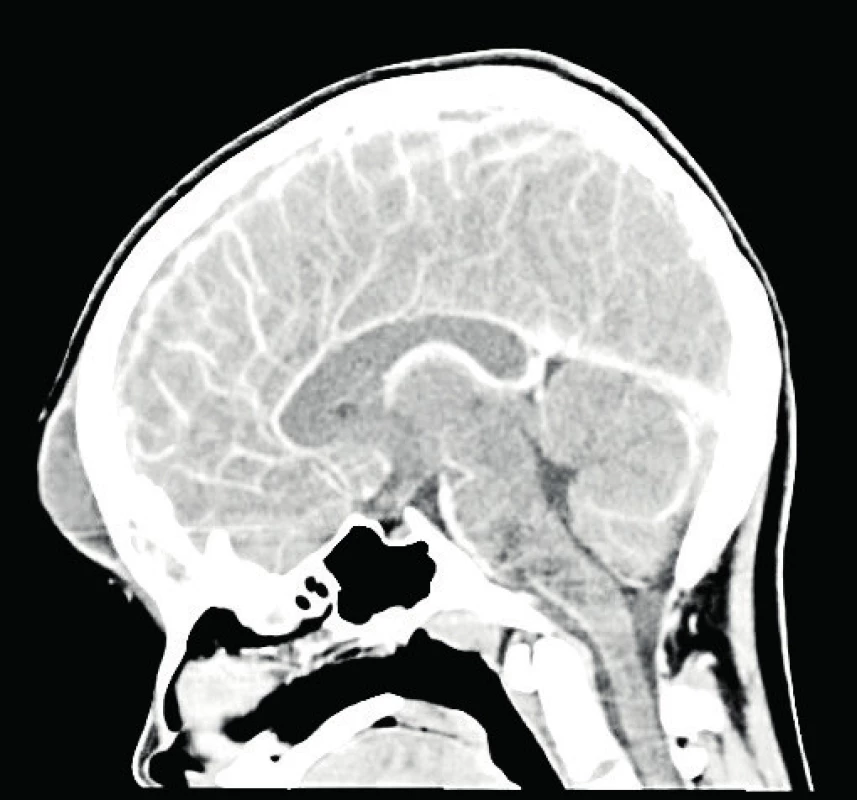 a, b (P1). Vstupní CT (1. hospitalizační den), ložisko
cerebritidy frontálně vpravo a subperiostální
absces po aplikaci kontrastní látky. (Za laskavého přispění MUDr. Pavla Rejtara)<br>
Fig. 3a, b (P1). The CT imaging (the first hospitalisation day),
the area of cerebritis in the right frontal area
and subperiosteal abscess after the contrast
agent administration. (Credit Dr. Pavel Rejtar)
