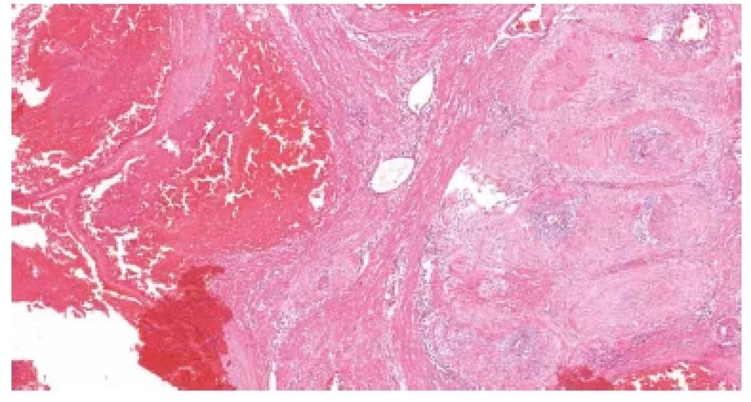 Subinvoluce cév lůžka placenty (placental site subinvolution). Útržky
myometria, v němž současně nacházíme volně průchodné i fyziologicky
uzavřené uteroplacentární cévy (HE, 50x).