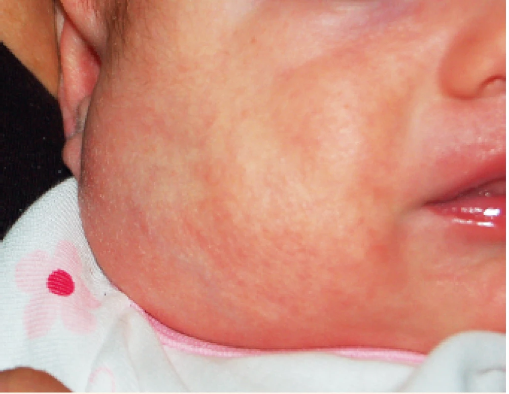Hluboký hemangiom v oblasti parotis.<br>
Deep parotid gland IH.
