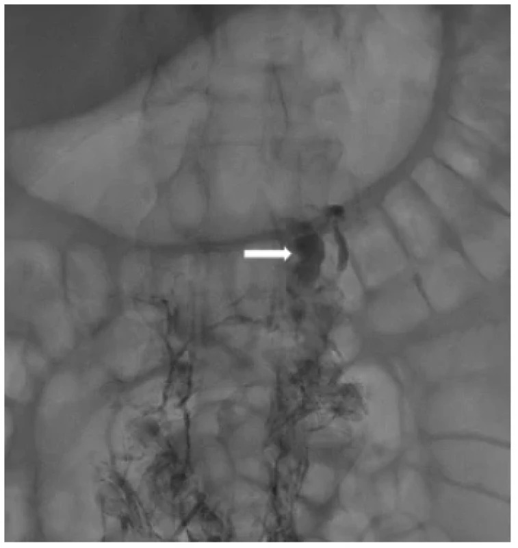 Naplnění cisterna chyli (bílá šipka) v plnicí fázi
lymfografie <br> 
Fig. 3. Opacification of the cisterna chyli (white arrow) during
filling phase of lymphography