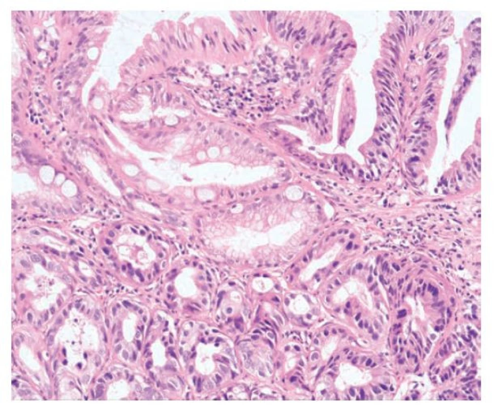 Kryptová dysplázie. Dysplastické změny v bazálních kryptách v terénu
intestinální metaplázie Barrettova jícnu. Povrchový epitel vyzrává (hematoxylin
a eosin, 200x).