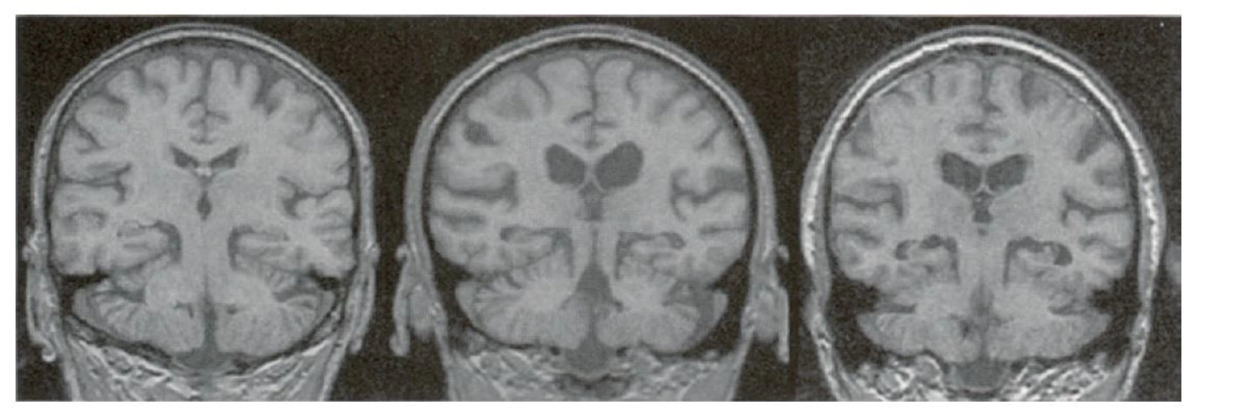 Zobrazení postupující atrofie hippocampu na MRI