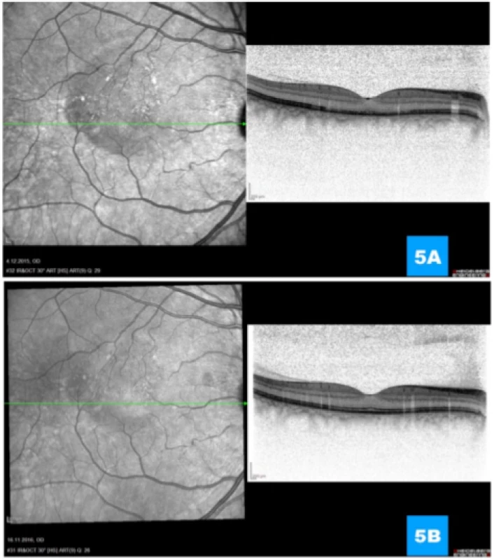 (A) Regression of activity of pathology with progressive normalisation of retinal layers 1 month and (B) 1 year
after performance of photodynamic therapy respectively 