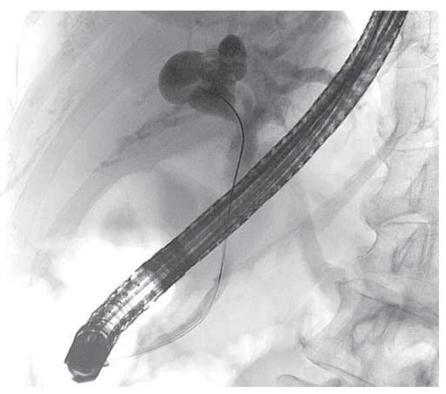 ERCP: masivní dilatace intrahepatálních žlučových
cest se zevním útlakem terminálního choledochu.<br>
Fig. 3. ERCP: massive dilatation of intrahepatic bile ducts
with external oppression of the terminal choledochus.
