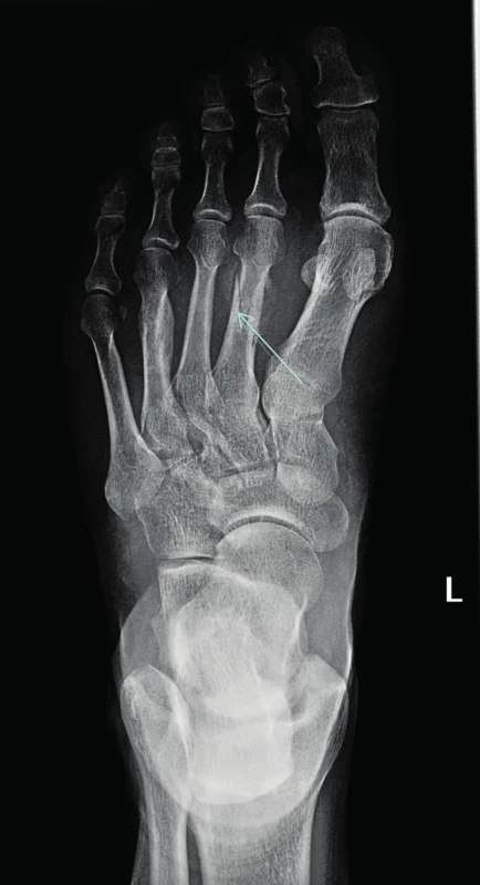 Atypická zlomenina (low energy fracture) v oblasti metatarzu
vzniklá u pacienta dlouhodobě léčebného bisfosfonáty