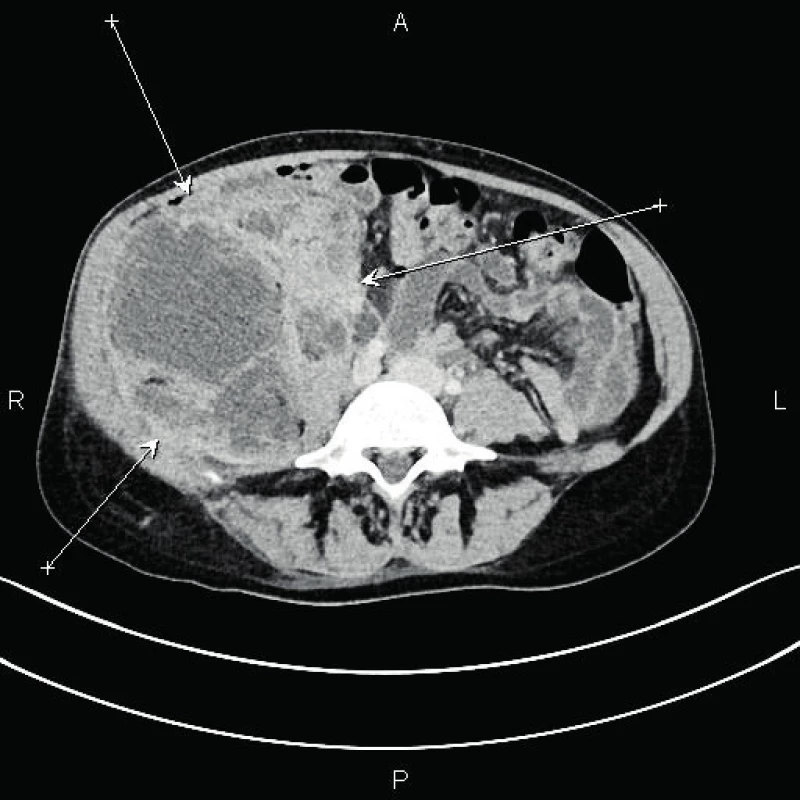Příčný řez retroperitoneálního abscesu