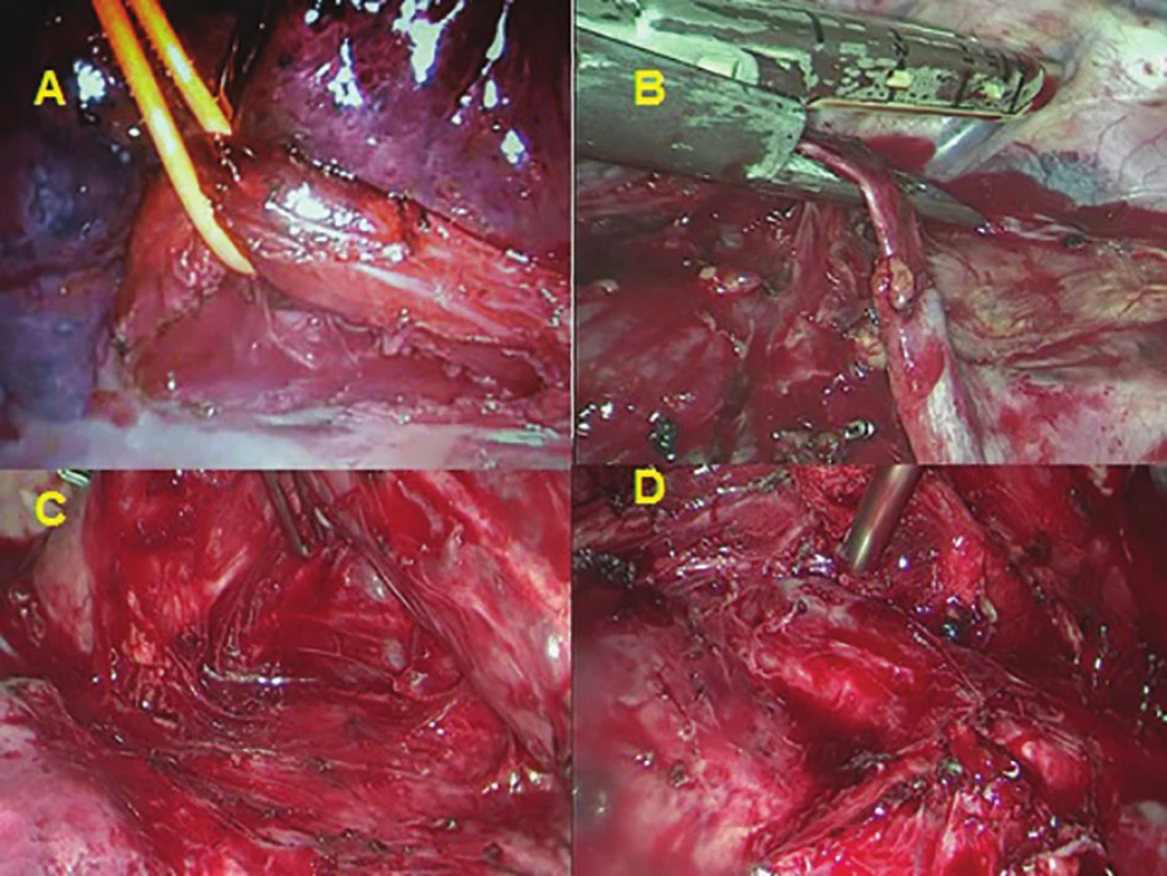 A) esophageal mobilization and elevation
(left lateral decubitus position); B) transsection
of azygos vein with endostapler (prone position);
C) lymphadenectomy along azygos vein (prone
position); D) lymphadenectomy along trachea and
bronchi (prone position)