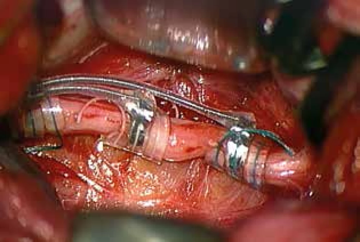 Elektroda na vagovém nervu<br>
Fig. 3: Electrode around the vagus nerve