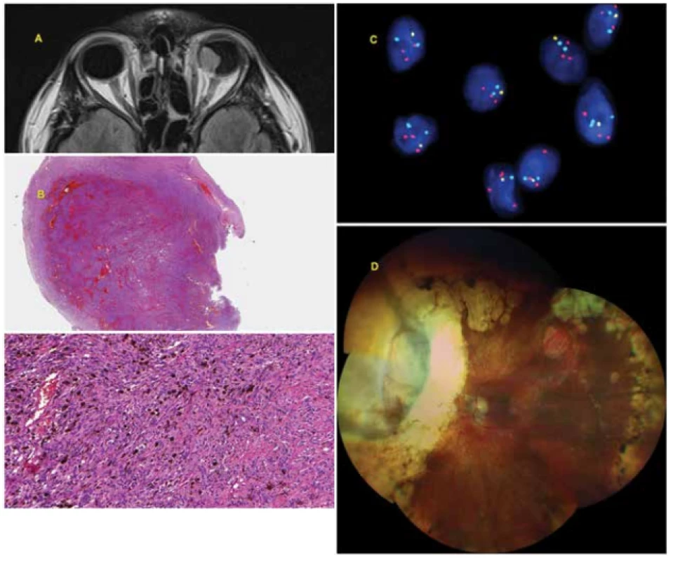 42-year-old man with advanced choroidal melanoma of the left eye, diagnosed in August 2009. In September 2009 he was treated with Leksell gamma knife, due to the size of the tumour with the risk of development of toxic tumour syndrome, exoresection of the 
tumour (sclerouvectotomy) was performed in October 2009. The cytogenetic examination was prognostically favourable (monosomy of 
chromosome 3 – negative, isochromosome 6p – positive, gain in chromosome 8q – negative). The patient is being regularly monitored 
(sonography of abdomen, X-ray of lungs, laboratory examination) – so far without signs of generalisation of the pathology.<br>
A: Advanced choroidal melanoma of left eye visible on MR image from August 2009.<br>
B: Histological finding – solid compact tumorous matter formed by spindle-cell elements and large quantity of melanin.<br>
C: Loss in area of short arm of chromosome 6 (6q) together with gain of long arm (6p) detected by FISH method with the aid of 
fluorescence set Vysis Melanoma FISH Probe Kit (Vysis, Abbot Molecular, USA). The locus of MYB (6q23) is indicated by yellow 
colour, the locus of RREB1 (6p25) by red colour, the control centromeric region by light blue (aqua) colour, the nuclei are tinged 
blue by DAPI. In normal nuclei 2 red, 2 yellow and 2 aqua signals are expected. The loss of 1 copy of locus MYB (1 yellow signal) 
and gain of locus RREB1 (3 red signals) is visible in the image.<br>
D: Finding on ocular fundus 10 years after uveal melanoma therapy (treatment by LGK, subsequent exoresection of tumour).
