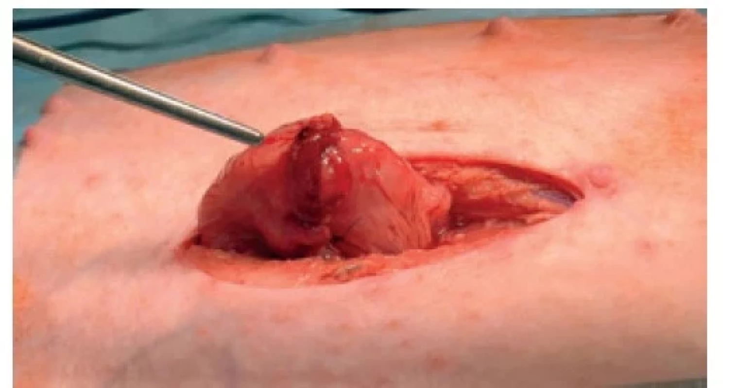 Již zkonstruovaná anastomóza s defektem antimezokolicky
a prominující sliznicí<br>
Fig. 4: Constructed anastomosis with a defect at the antimesocolic
side and with protruding mucous membrane