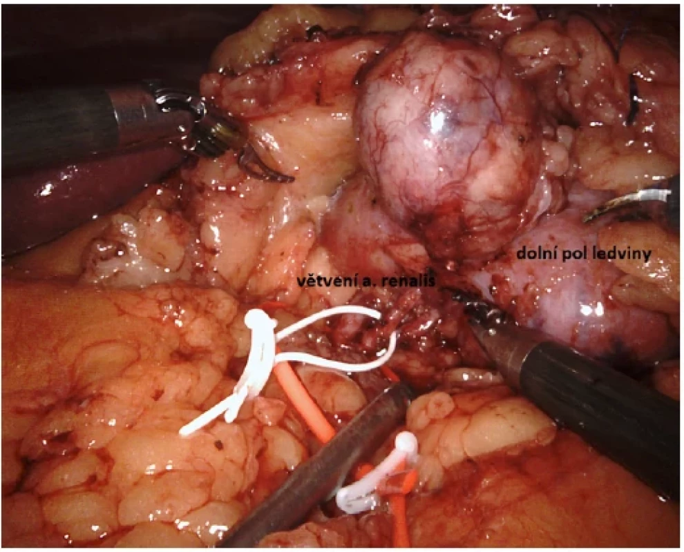 Rozpreparovaný hilus na jednotlivé větve arteria renalis <br> 
Fig. 2. Hilus dissected into individual branches of the renal artery