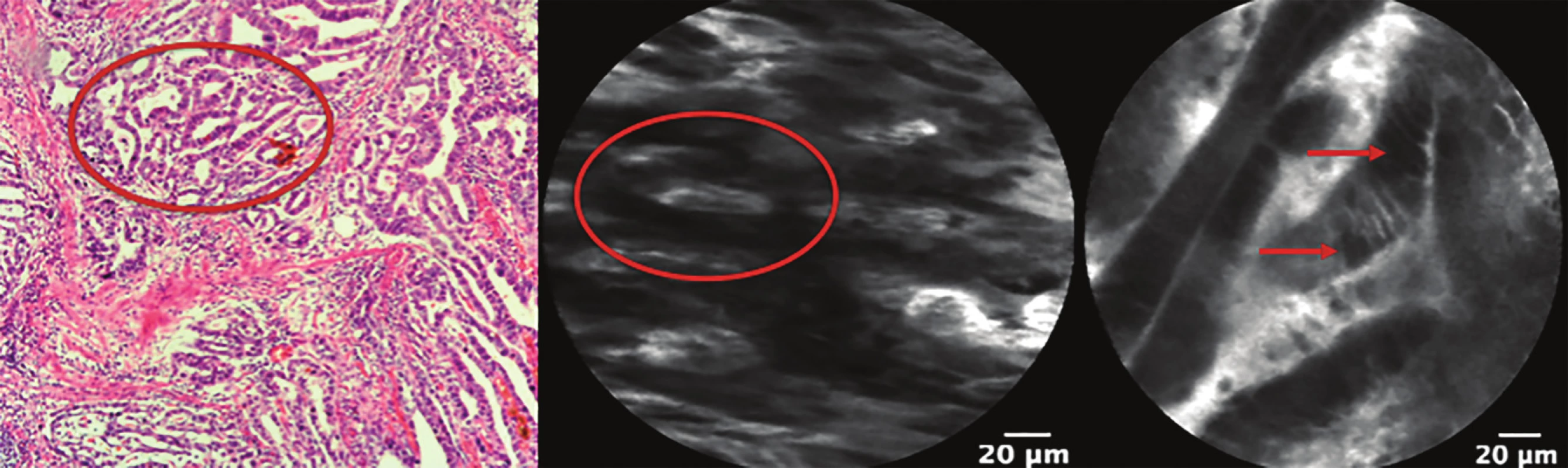 Dobře až středně diferencovaný adenokarcinom jícnu<br>
Šipky ukazují cytologické změny. Kroužek označuje tubulární a kribriformní struktury karcinomu (znak diferenciace).<br>
Fig. 4: Well to moderately diff erentiated carcinoma of the esophagus<br>
Arrows show cytological atypia. Circle marks tubular and cribriform structures of the carcinoma (character of the differentiation).