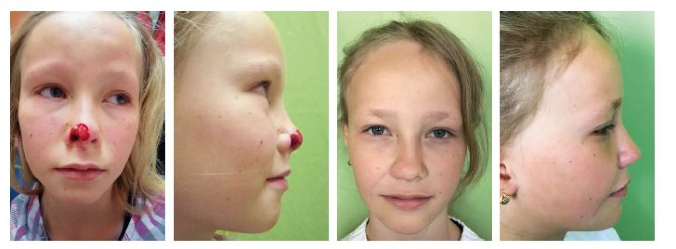 Případ 1 – ztráta nosního křídla po ukousnutí psem: A, B) úrazový stav, C, D) stav 1 rok po rekonstrukci.