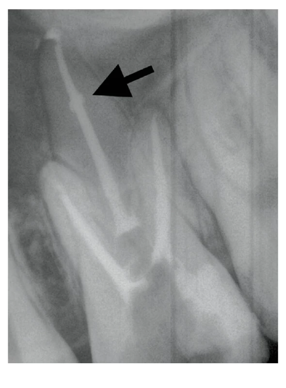 RTG snímek zobrazující schopnost sealeru vyplnit nepravidelnosti kořenového kanálku jako prostor způsobený vnitřní resorpcí <br>
Fig. 6 X-ray image showing the ability of a bioceramic-based sealer to fill irregularities in the root canal space, eg the space caused by internal resorption