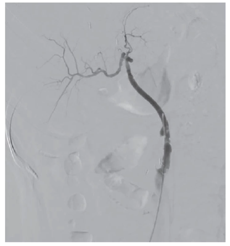 Stav po implantácii stentgraftu<br>
Fig. 3: After stentgraft placing