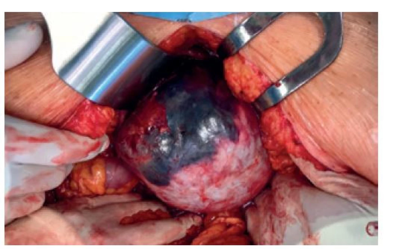 Aneuryzma a. hepatica communis s patrnou rupturou
při laparotomii<br>
Fig. 2: Ruptured common hepatic artery aneurysm exposed
in laparotomy
