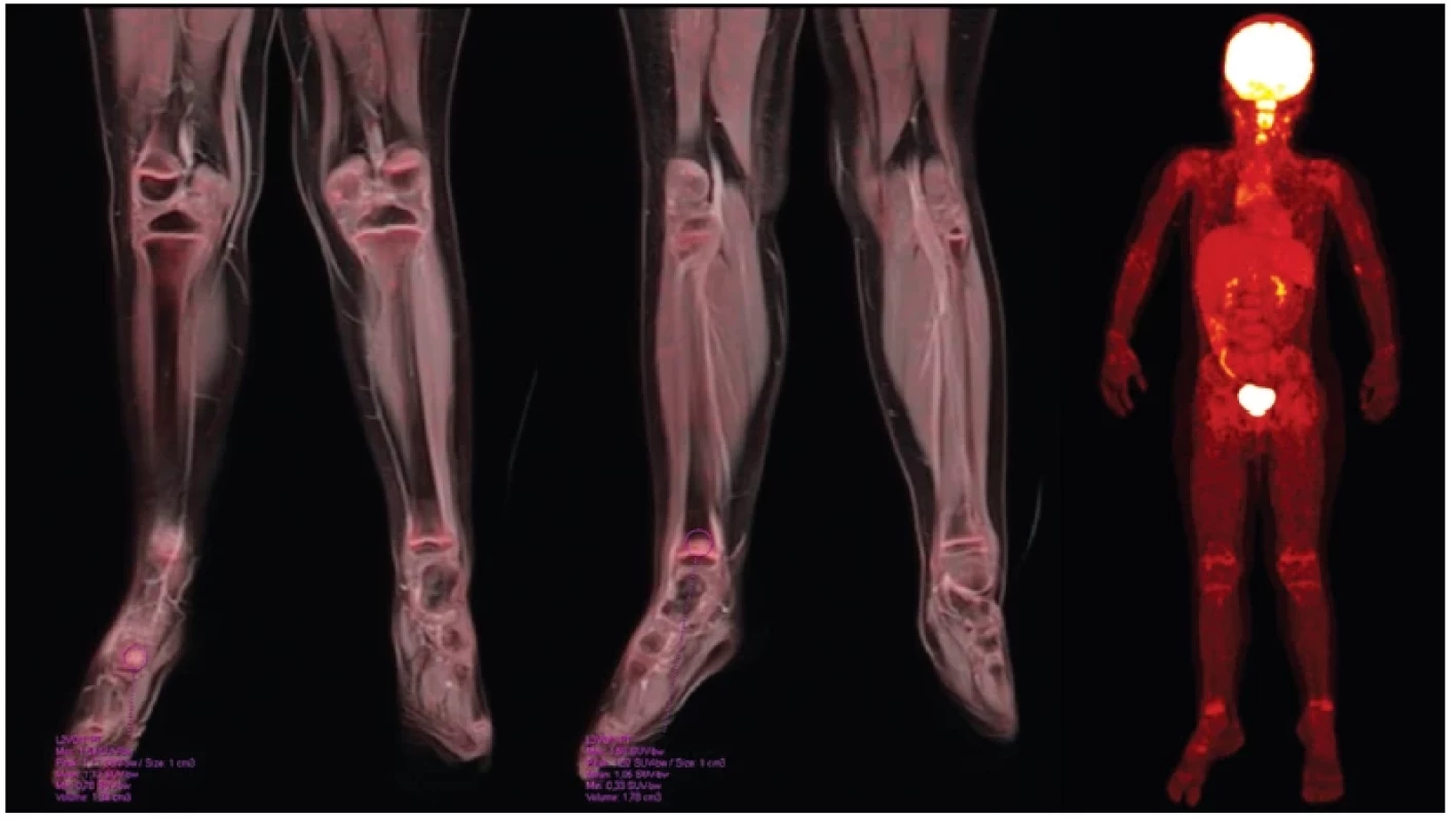 Sedmiletá dívka s chronickou rekurentní multifokální osteomyelitidou (CRMO), vyšetření s 18F-FDG, PET/MRI fúze, PET obraz,
zobrazení zvýšené metabolické aktivity v postižených částech skeletu – distální metafýza pravé tibie a v os cuboideum, současně aktivita
v růstových ploténkách