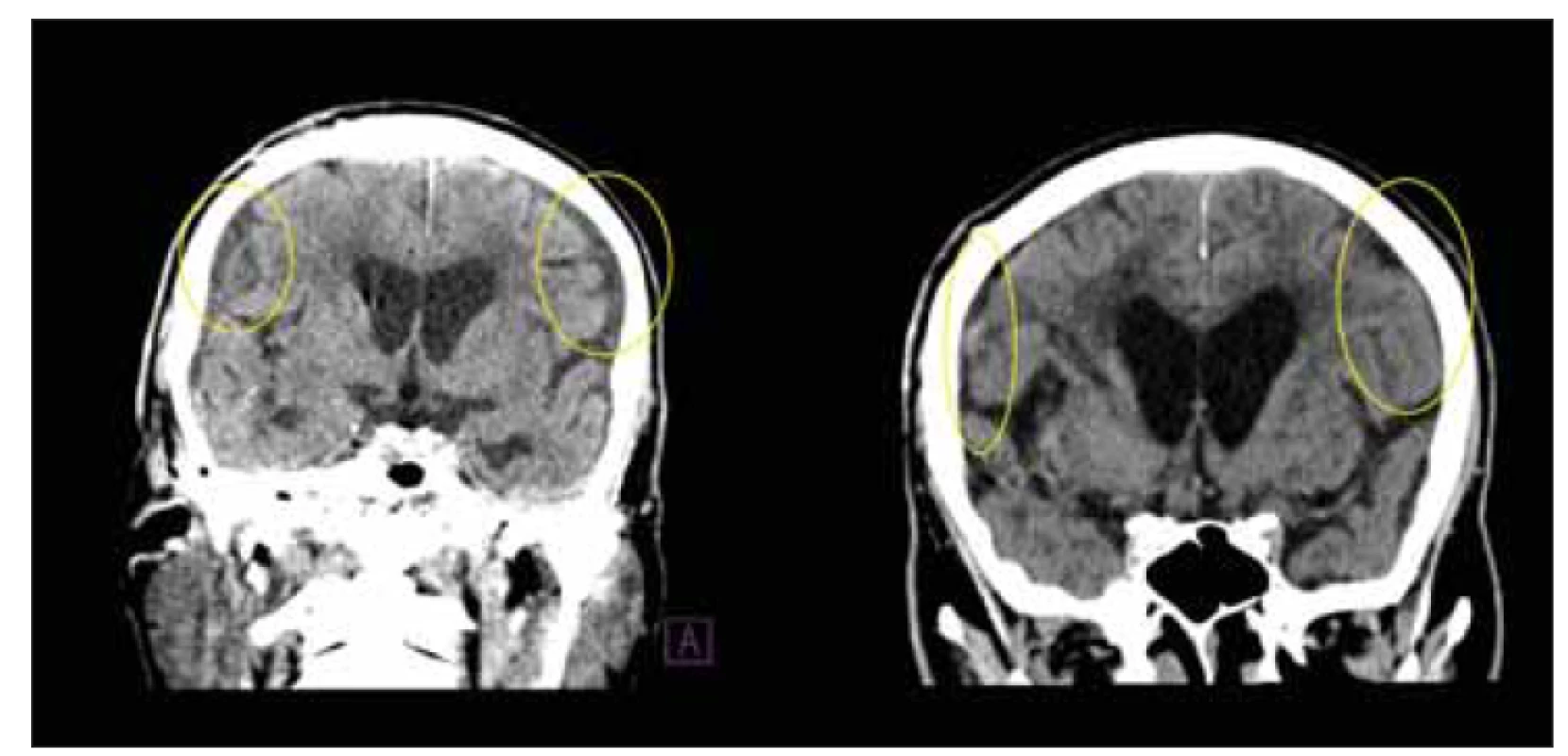 CT, frontální rovina. Subdurální kolekce u pacienta po implantaci ventrikuloperitoneálního
zkratu. Otevírací tlak ventilu byl navýšen. Na kontrolní CT po 14 dnech došlo
ke vstřebání kolekcí (žluté kruhy).<br>
Fig. 10. CT, coronal plane. Subdural collections in a patient after ventriculoperitoneal
shunt implantation. The valve opening pressure has been increased. After 14 days, the
collections were absorbed on the control CT (yellow circles).