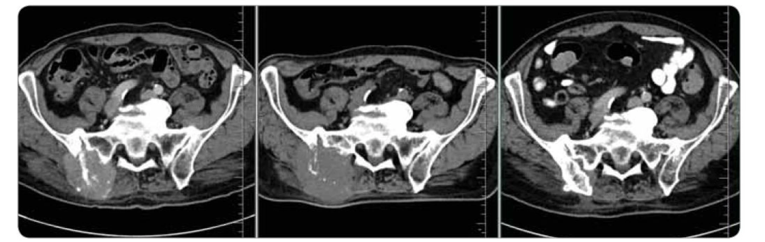 Vývoj osteolytického ložiska v kosti kyčelní vpravo – progrese před radioterapií, regrese měkkotkáňové složky a remineralizace
kosti po radioterapii. CT snímky, transverzální řez. Datum: 7. 4. 2021 (diagnostické vyšetření), 23. 4. 2021 (plánovací vyšetření)
a 14. 3. 2022 (kontrolní vyšetření).
