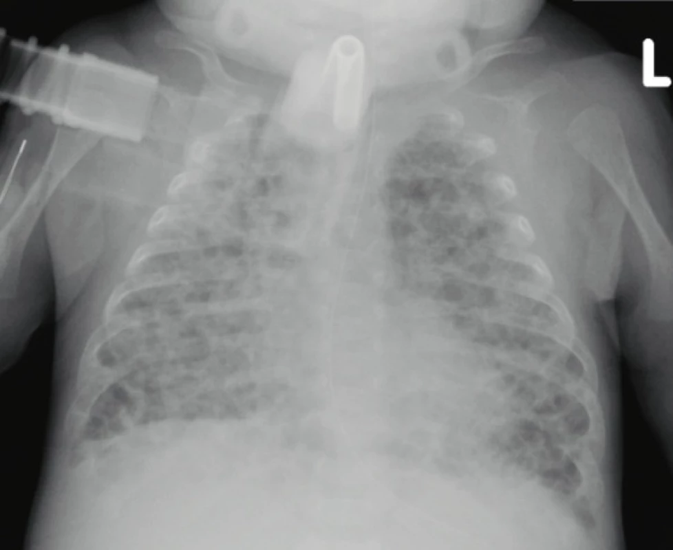 Skiagram hrudníku 3měsíčního chlapce narozeného
ve 24. gestačním týdnu, nález těžkých fibroproliferativních a emfyzematózních změn připomíná obraz „old“
BPD (archiv Radiodiagnostické kliniky 1. LF UK a VFN).<br>
Fig. 1. Chest X-ray of a 3-month-old boy born in the 24th gestational week, the finding of severe fibroproliferative
and emphysematous changes resembles the image of
„old“ BPD (archive of the Department of Radiology,
First Faculty of Medicine, Charles University and
General University Hospital in Prague).