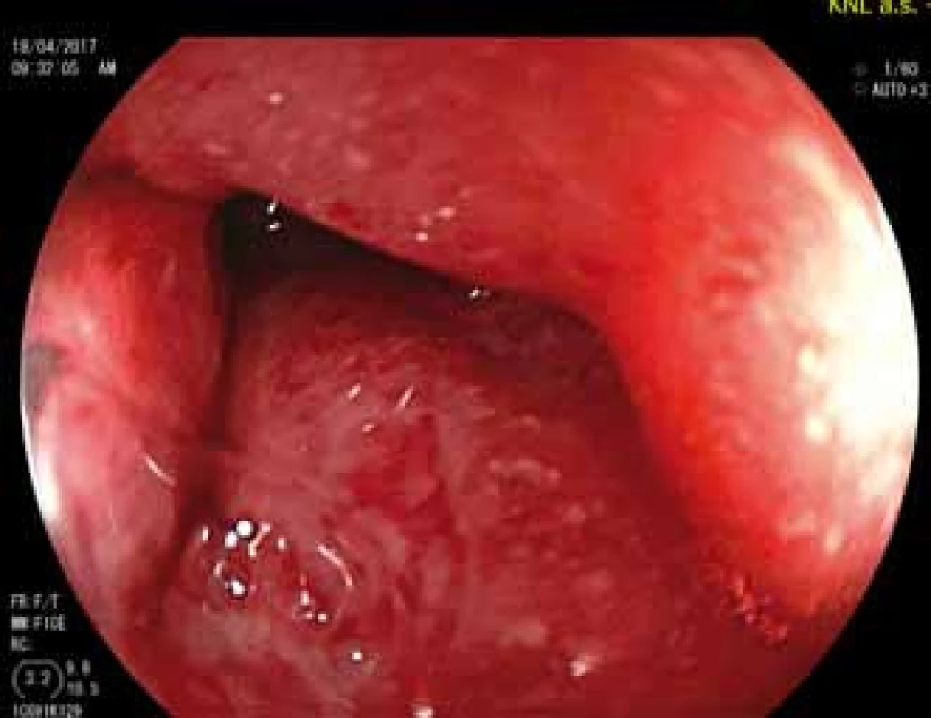 Pahýl rekta před zahájením
léčby ustekinumabem.<br>
Fig. 1. The rectal stump before ustekinumab
is started