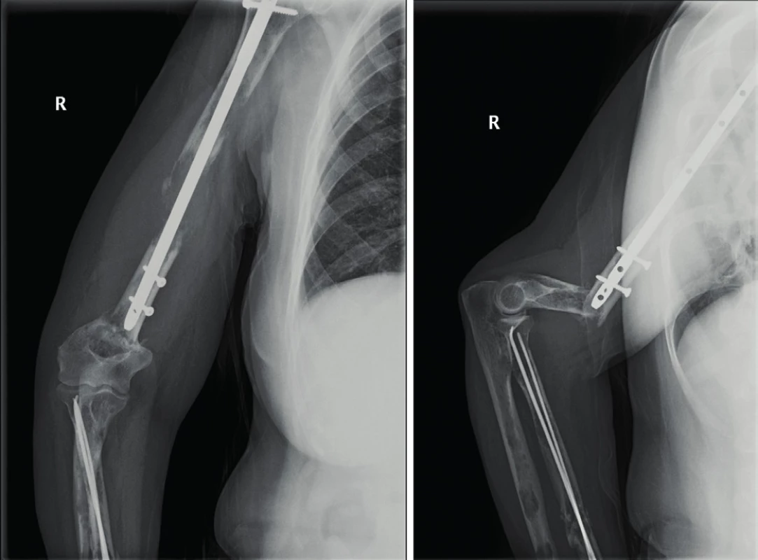 Žena, 62 let, RTG pravého humeru, kde je patrná periimplantátová zlomenina, lokalizovaná pod distální konec hřebu. Původní fraktura v osteolytickém ložisku je zajištěna intramedulárním hřebem