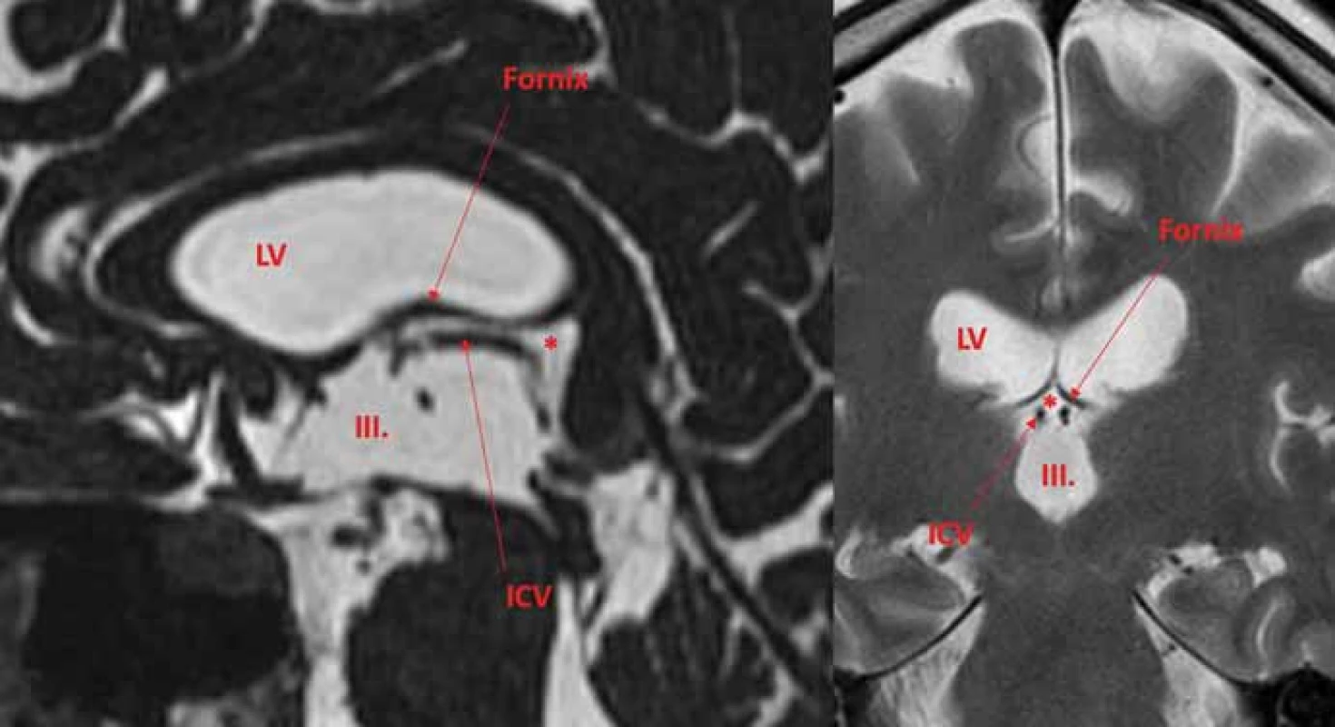 Velum interpositum (*) je subarachnoidální prostor mezi stropem III. komory
a fornixy. Obsahuje ICV. Leží mimo III. komoru a LV a za normálních okolnosti komunikuje
se suprapineální části quadrigeminální cisterny.
ICV – vnitřní mozková žíla; LV – postranní komora<br>
Fig. 2. Velum interpositum (*) is a subarachnoid space between the roof of the IIIrd ventricle
and the fornices. It contains ICV. It lies outside the IIIrd ventricle and LV and normally
communicates with the suprapineal part of the quadrigeminal cistern.
ICV – internal cerebral veins; LV – lateral ventricle