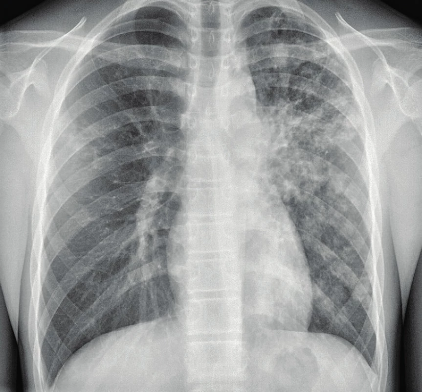 SKG hrudníku 16letého chlapce s hemoptýzou.
Mikroskopicky a kultivačně pozitivní tuberkulóza
vlevo, forma TB pneumonie, forma bronchopneumonická.<br>
Fig. 4. Chest X-ray of 16 years old boy with hemoptysis.