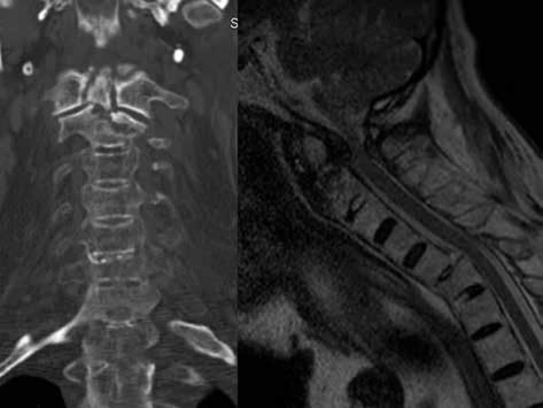 A: Případ 71letého pacienta přijatého se zlomeninou zubu a  laterální masy C2 společně s  příčnou transdiskální zlomeninou C5/6 <br>
Fig. 1A: The case of a 71 years old male patient with an odontoid fracture, fracture of the C2 lateral mass and transdiscal C5/6 fracture
