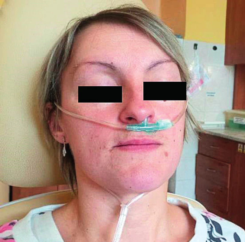 Úprava kyslíkových brýlí k umožnění měření přístrojem
– část kyslíkových brýlí určená k vložení do nostrily vlevo je
ustřižena a přelepena páskou, měření pak probíhá pro každou
stranu zvlášť pouze pomocí části kyslíkových brýlí určených k vložení
do nostrily vpravo.