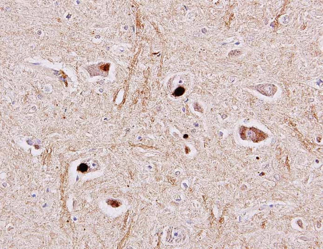 Různé typy inkluzí v perikariu motorických neuronů předních rohů míšních pozitivní
v imunohistochemickém průkazu pomocí protilátky proti proteinu TDP-43 (šipky).
Původní zvětšení 400×.<br>
Fig. 3. Different types of inclusions in the cytoplasm of the spinal cord motor neurons
identified as positive in the immunohistochemical reaction using antibody against TDP-
43 protein (arrows). Original magnification 400×.