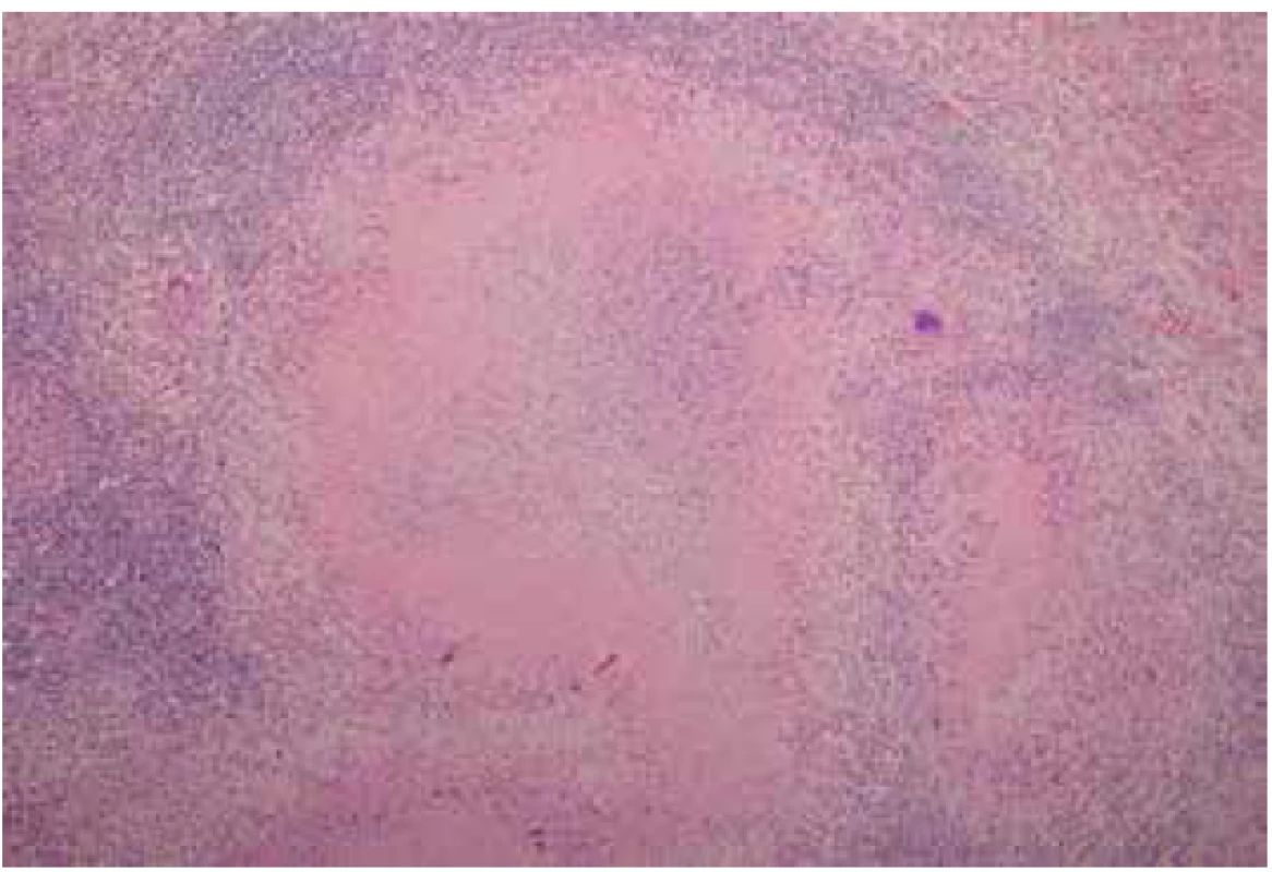 Histologický nález TBC sleziny – mikroskopie<br>
Fig. 2. Histological finding of splenic TBC – microscopy