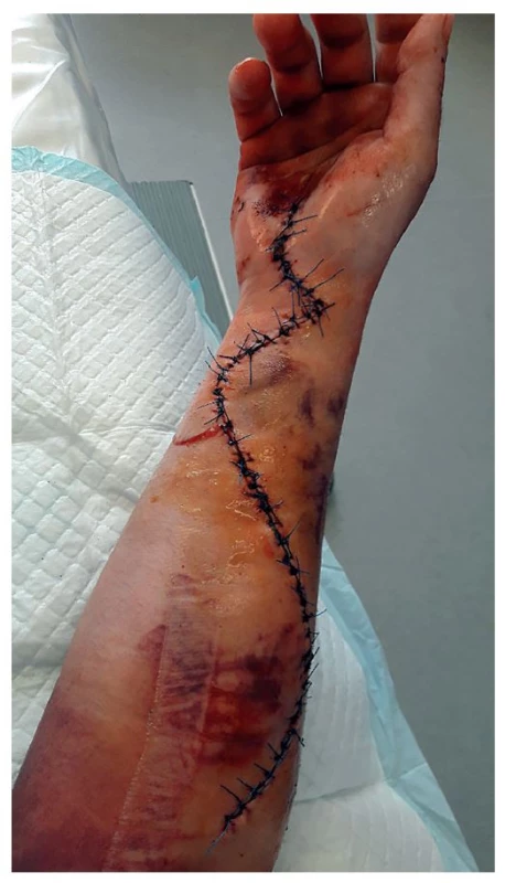 Pravé předloktí volárně, 8. pooperační den<br>
Fig. 5: Volar view of the right forearm, postoperative day 8