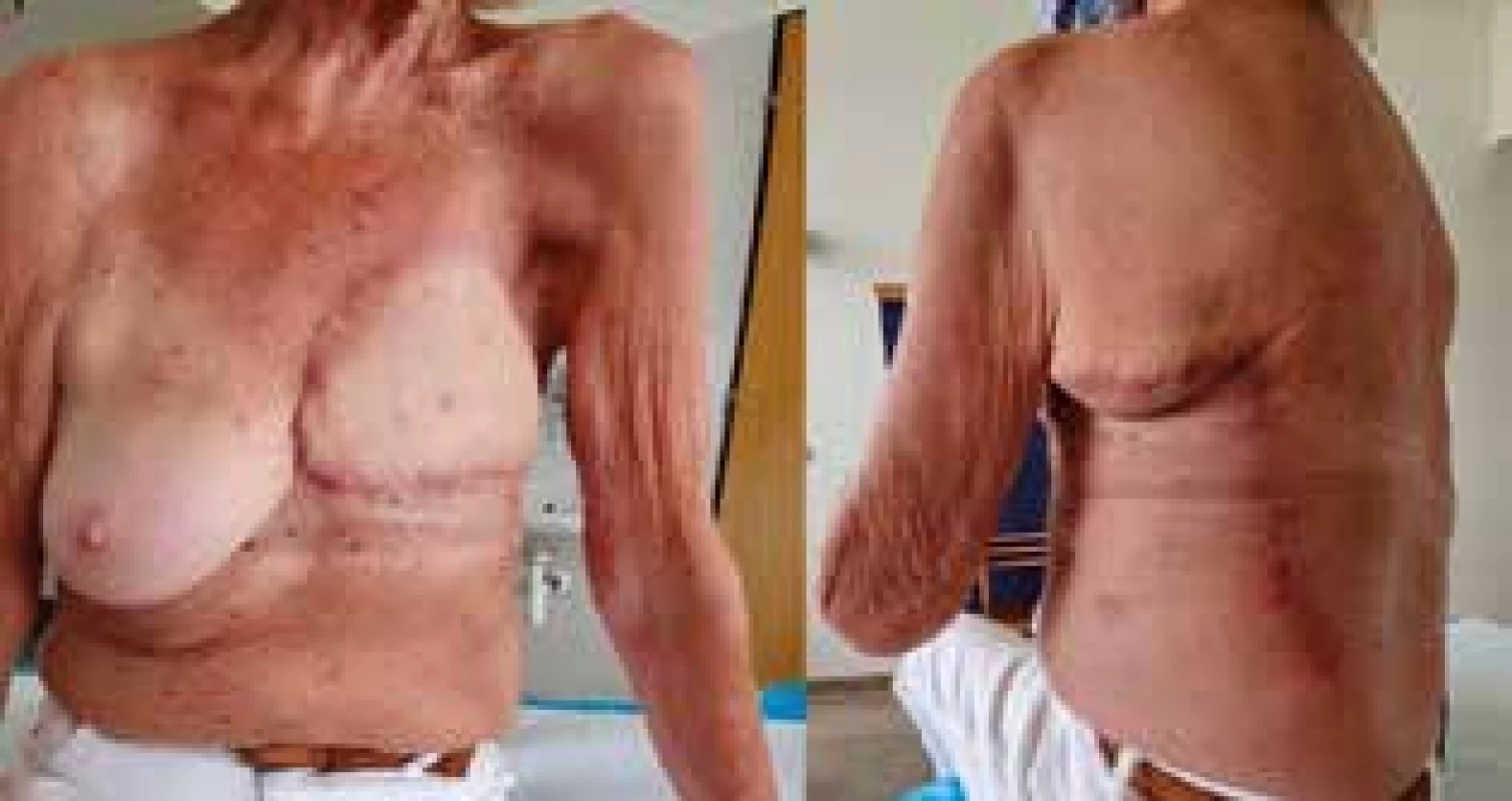 Při ambulantní kontrole měsíc po operaci<br>
Fig. 6: One month after the surgery