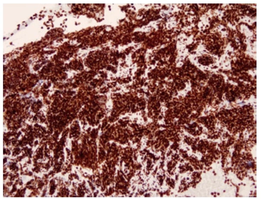 Malobuněčný karcinom pozitivní v imunohistochemickém průkazu
NEUROD1. 100x