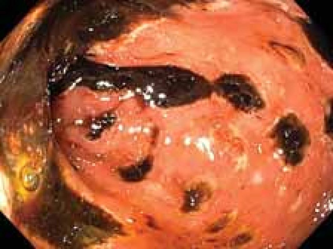Mnohočetné cirkulární 
ulcerace duodena s hematinem na 
spodině.
Fig. 1. Multiple circular duodenal 
ulcerations covered with hematin.