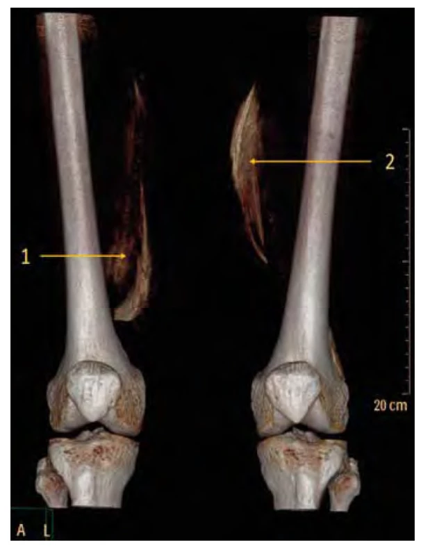 CT obraz 3D rekonstrukce: porovnání šíření LA po aplikaci LA
v trigonum femorale a v distálním konci canalis adductorius. 1. tvar fasciálních
struktur po aplikaci 20 ml LA do distální části canalis adductorius
„mercedes sign“. 2. tvar fasciálních struktur po aplikaci 20 ml LA do oblasti
trigonum femorale