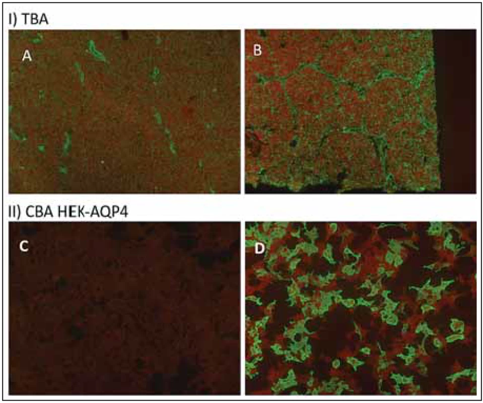 Tkáňové řez a cell-based assay u AQP4-IgG pozitivního pacienta.<br>Fig. 2. Tissue based assay and cell-based assay for AQP4-IgG.