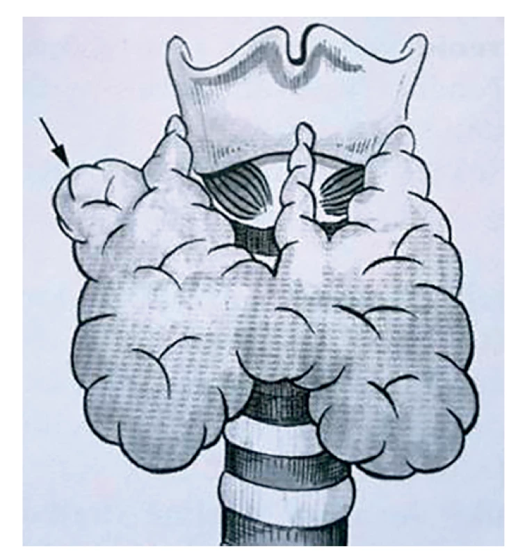 Tuberculum Zuckerkandli<br>
Fig. 1: Zuckerkandl‘s tubercle