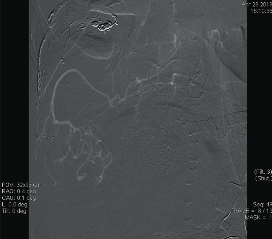 Digitální subtrakční angiografie a. lumbalis dextra:
zobrazuje se patologická vaskularizace angiolipomu [6]