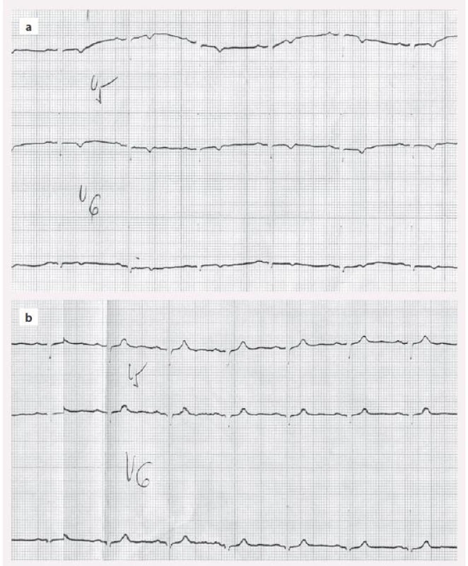 EKG u hypotyreózy – a) negativní T u neléčené hypotyreózy, b) normalizace po
léčbě levotyroxinem.