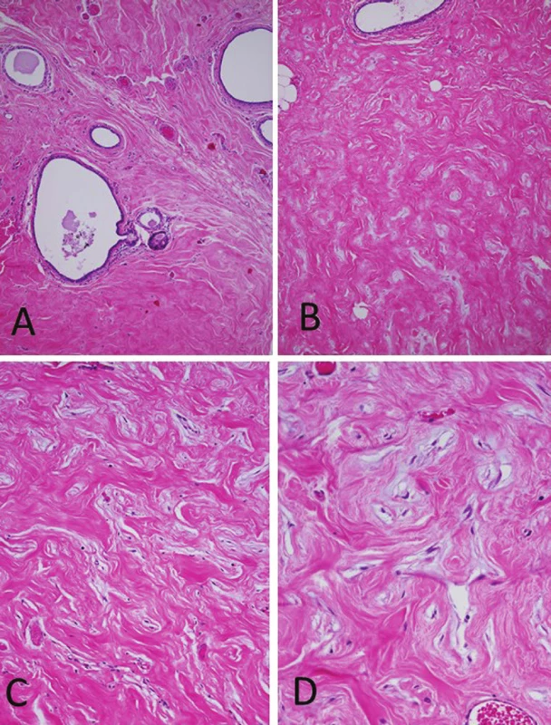 Histopathology of the axillary breast tissue. (A) Aberrant axillary breast
tissue including ectatic mammary ducts, absence of acinar tissue and increase
of the fibrous tissue (H&E, original magnification x100). (B) Interlobular stroma
showing elongated slit-like spaces lined by flattened spindle cells (H&E, original
magnification x100). (C) The spaces are empty, devoid of red blood cells (H&E,
original magnification x200). (D) Keloid-like fibrosis containing slit-like spaces
that simulate vascular channels. No cytologic atypia or mitotic activity was seen
in the spindle cells (H&E, original magnification x400).