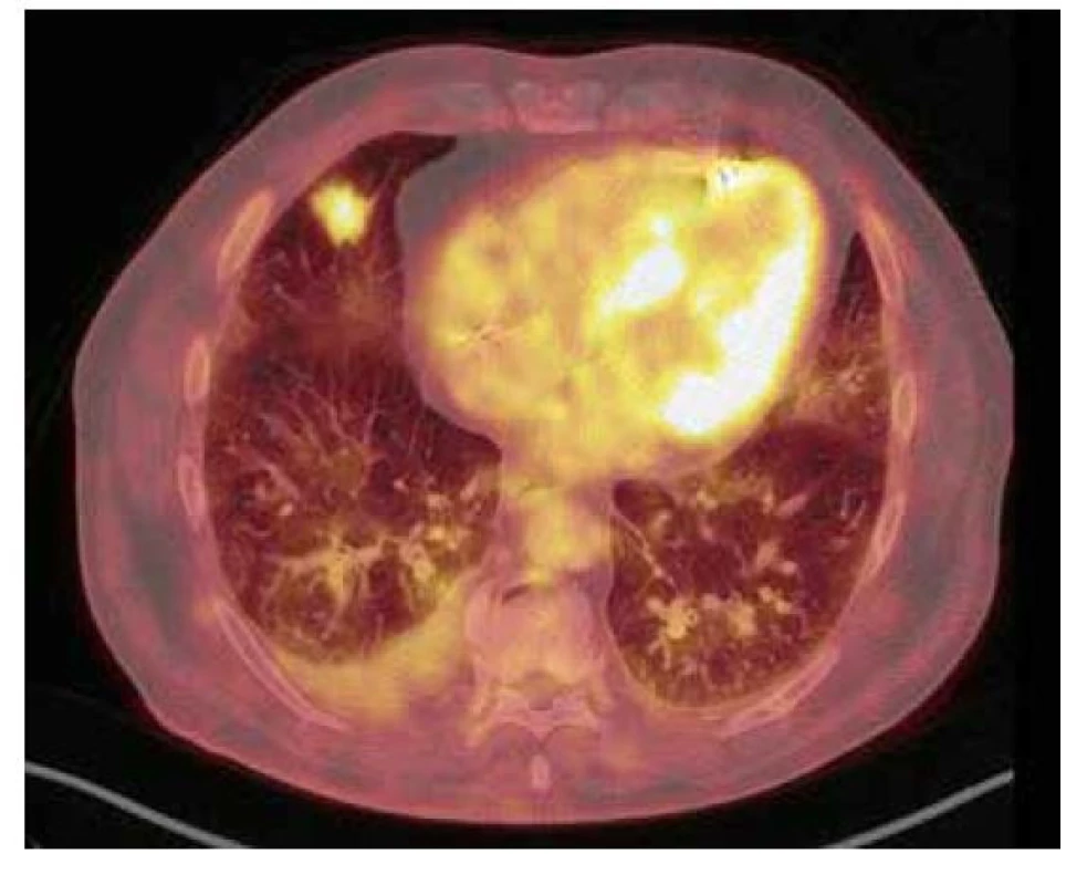 18F-FDG PET/CT vyšetření hrudníku před resekcí suspektního
ložiska – zobrazuje se mírná akumulace FDG v nepravidelném cípatém
ložisku v S4 pravé plíce velikosti 25 × 19 × 18 mm (SUVmax 5,2)
