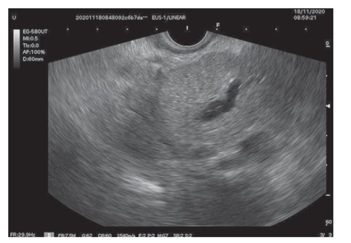 Endosonografický obraz zväčšenej hlavy pankreasu
a rozšíreným ductus Wirsungi (diameter 10 mm).<br>
Fig. 3. Endosonographic image of the enlarged head of the
pancreas and the enlarged ductus Wirsungi (diameter 10 mm).