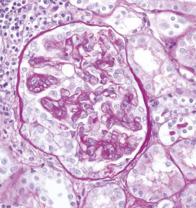 Glomerulus se segmentálním epitelovým srpkem
(šipky), bez ruptury Bowmanova pouzdra a se zánětem
v okolním intersticiu (PAS).<br>
Fig. 3. Glomerulus with segmental epithelial crescent
(arrows), without Bowman capsule rupture and with inflammation
in the surrounding interstitium (PAS).