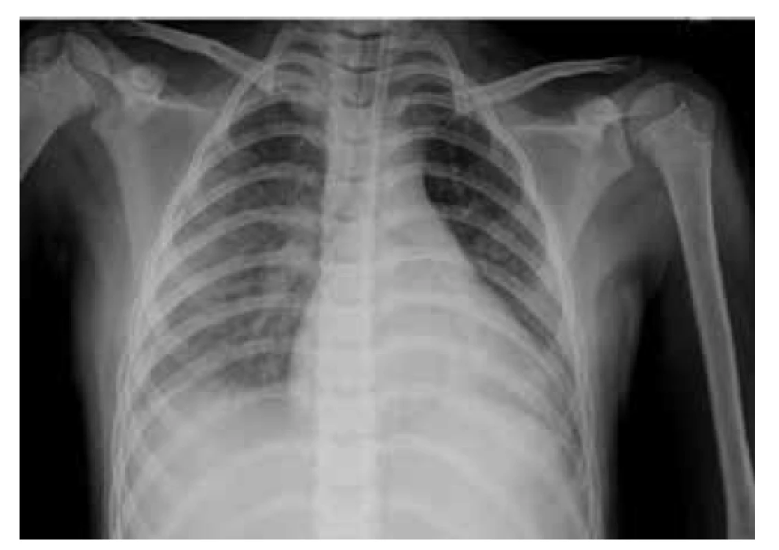 RTG vyšetrenie pľúc pacienta z klinického prípadu 1
– prítomné bronchopneumonické zmeny viac vpravo s naznačeným
fluidothoraxom bilaterálne.<br>
Fig. 1. X-ray examination of the patient’s lungs from case report
1 – bronchopneumonic changes more to the right with
bilateral pleural effusions.