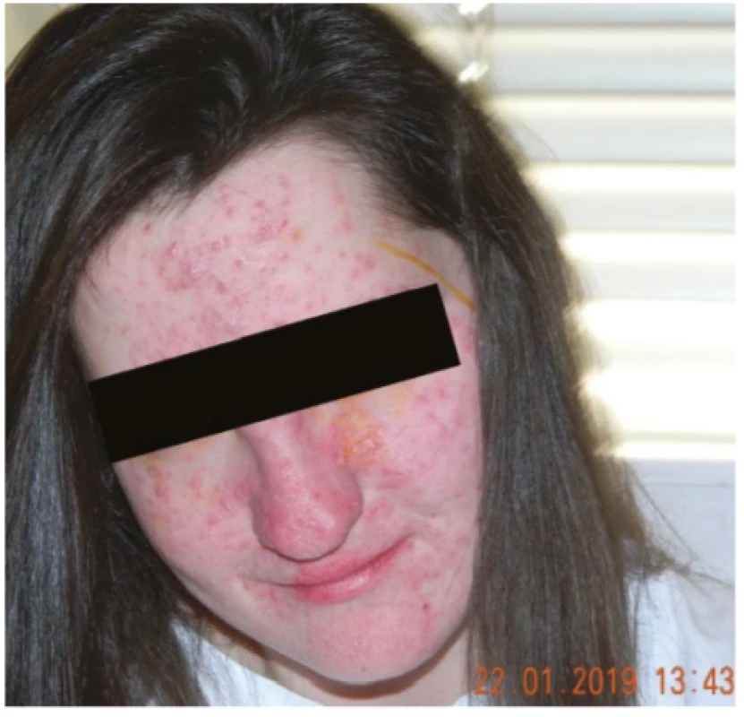 Face of patient from case report 1, papulopustules
with crust visible on face